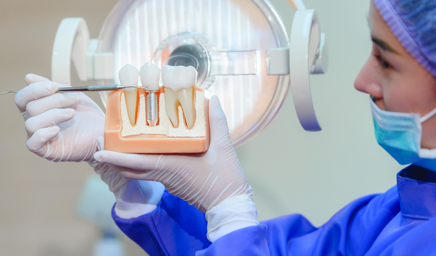 What Is a Dental Implant?